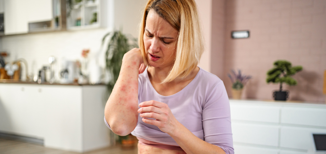 Jak wygląda alergia skórna? Objawy i leczenie
