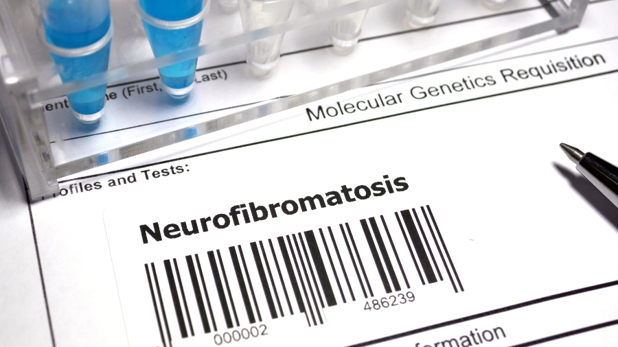 Neurofibromatoza - co to za choroba genetyczna?