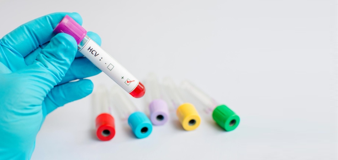 Wirus HCV - jak można się nim zarazić, jakie ma objawy i jak go leczyć