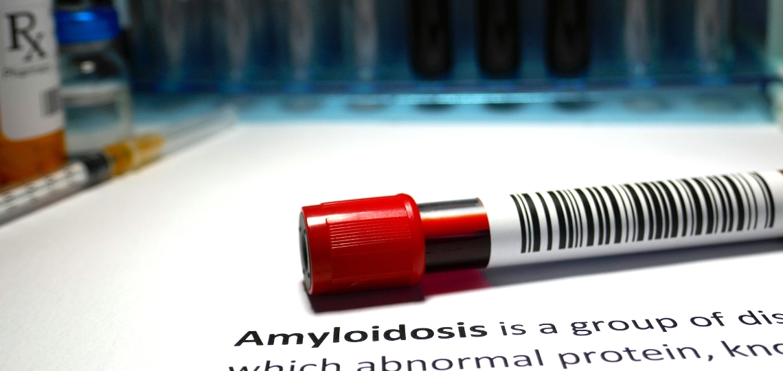 Amyloidoza - przyczyny, objawy, leczenie