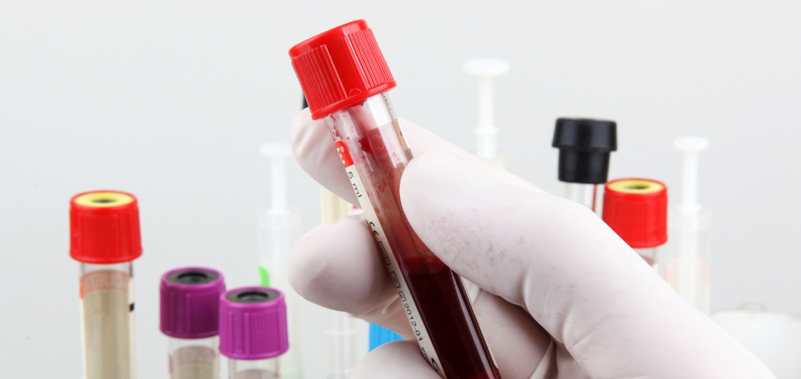 Anemia sierpowata badania
