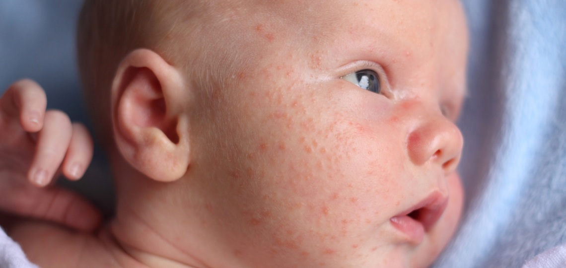 Trądzik niemowlęcy – czym jest? | Apteka Nowa Farmacja
