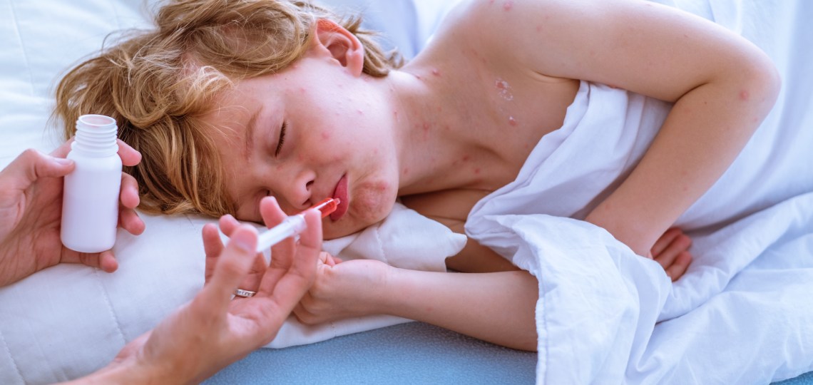 Ospa u dziecka | Apteka Nowa Farmacja