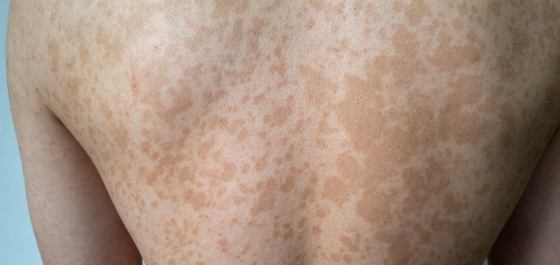 Łupież pstry - na jakich częściach ciała najczęściej występuje? | Apteka Nowa Farmacja
