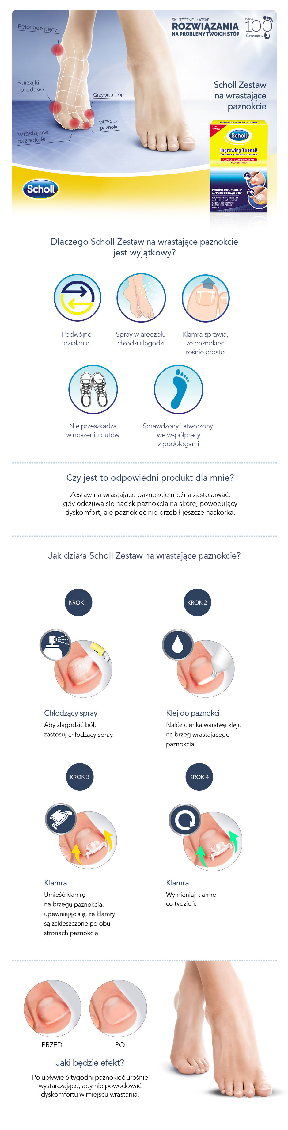 SCHOLL Ingrowing Toenail - Zestaw na wrastające paznokcie, klamry i spray, 1 sztuka